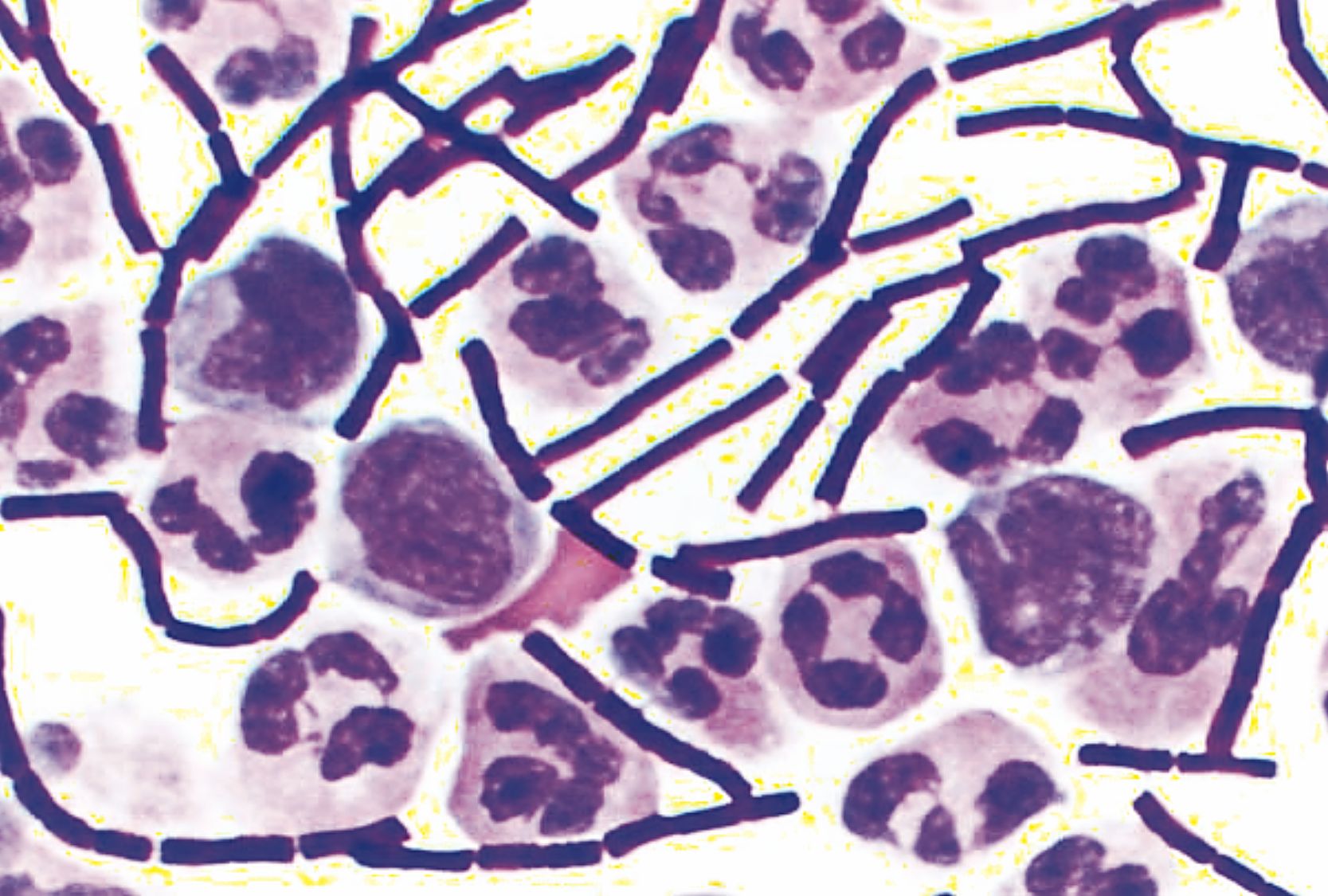 Second case of anthrax found in South Dakota | TSLN.com