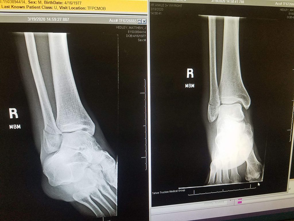 I knew we had it handled': Truckee skier makes it out of backcountry with broken  leg | SierraSun.com, image size:1024x768