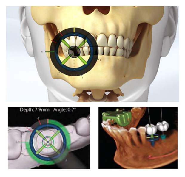 Advances in dental technology make implants safer than ever